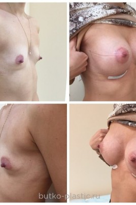 Тубулярная грудь порно (64 фото)